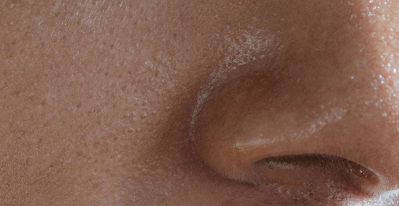 enlarged skin pores